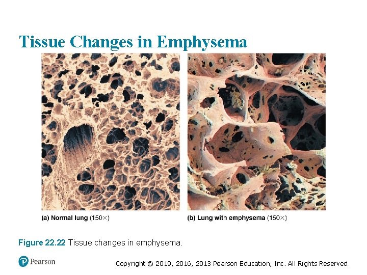 Tissue Changes in Emphysema Figure 22. 22 Tissue changes in emphysema. Copyright © 2019,