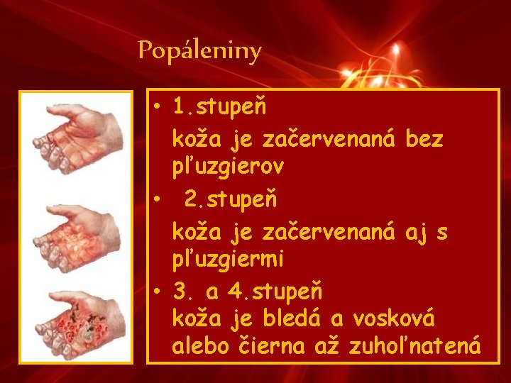 Popáleniny • 1. stupeň koža je začervenaná bez pľuzgierov • 2. stupeň koža je