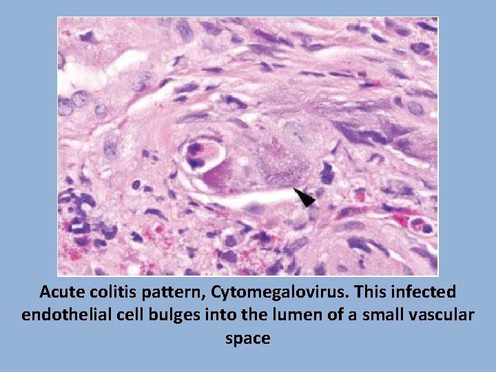 Acute colitis pattern, Cytomegalovirus. This infected endothelial cell bulges into the lumen of a