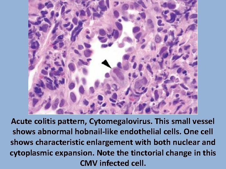 Acute colitis pattern, Cytomegalovirus. This small vessel shows abnormal hobnail-like endothelial cells. One cell