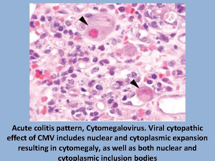 Acute colitis pattern, Cytomegalovirus. Viral cytopathic effect of CMV includes nuclear and cytoplasmic expansion