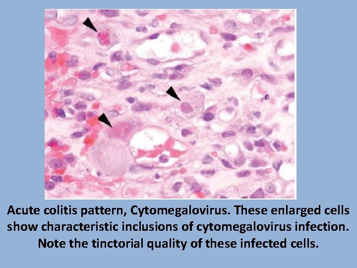 Acute colitis pattern, Cytomegalovirus. These enlarged cells show characteristic inclusions of cytomegalovirus infection. Note