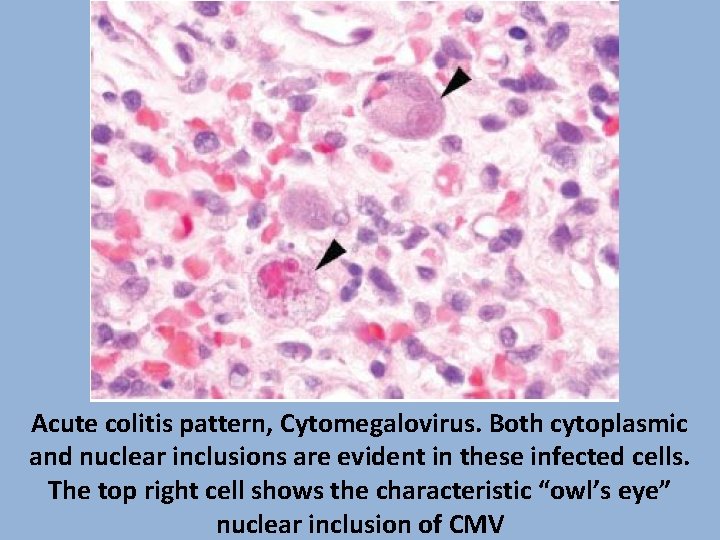 Acute colitis pattern, Cytomegalovirus. Both cytoplasmic and nuclear inclusions are evident in these infected