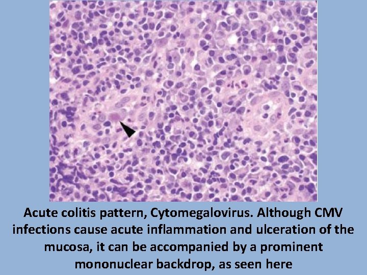 Acute colitis pattern, Cytomegalovirus. Although CMV infections cause acute inflammation and ulceration of the