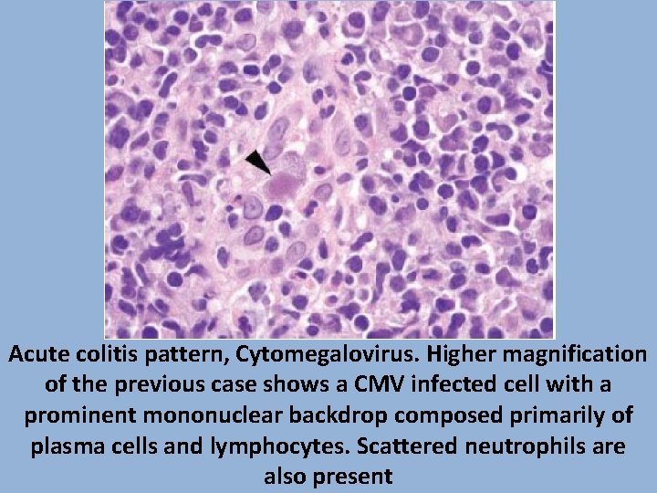 Acute colitis pattern, Cytomegalovirus. Higher magnification of the previous case shows a CMV infected