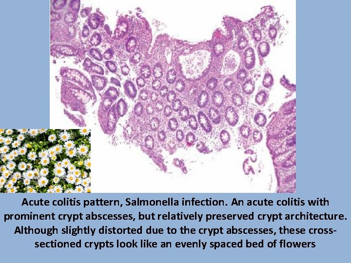 Acute colitis pattern, Salmonella infection. An acute colitis with prominent crypt abscesses, but relatively