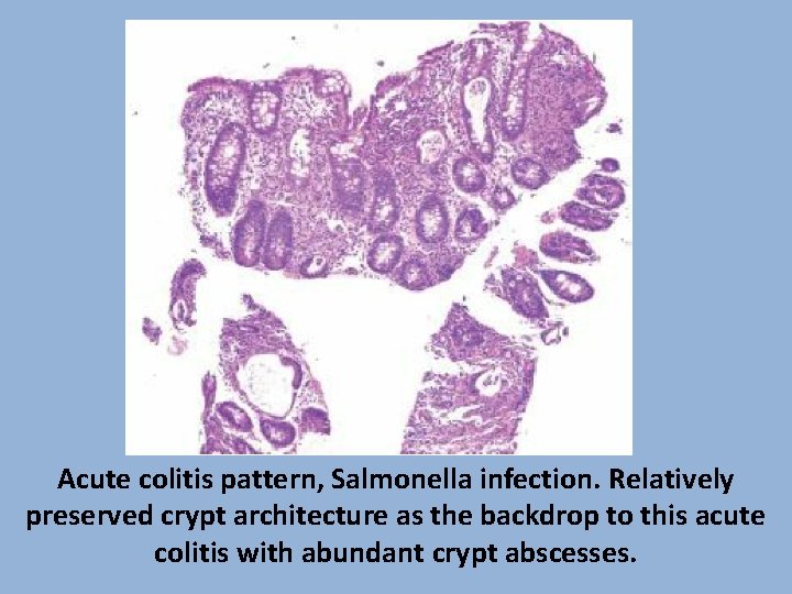 Acute colitis pattern, Salmonella infection. Relatively preserved crypt architecture as the backdrop to this