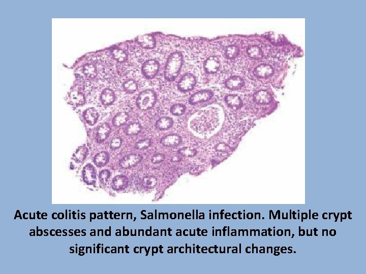 Acute colitis pattern, Salmonella infection. Multiple crypt abscesses and abundant acute inflammation, but no