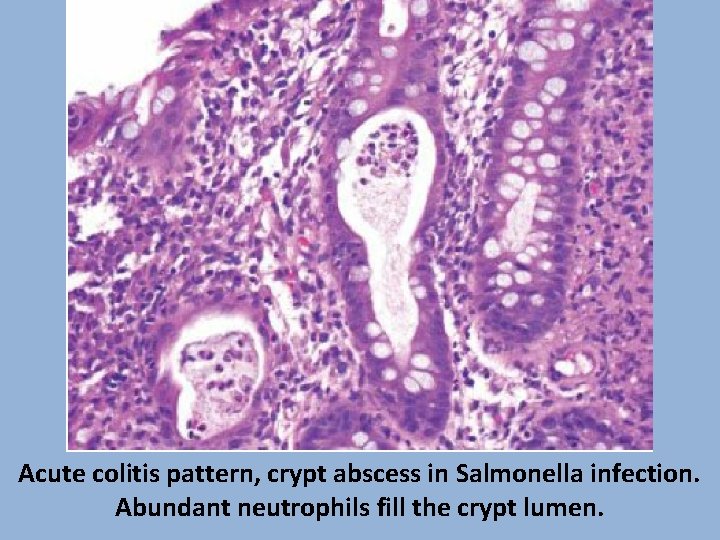 Acute colitis pattern, crypt abscess in Salmonella infection. Abundant neutrophils fill the crypt lumen.