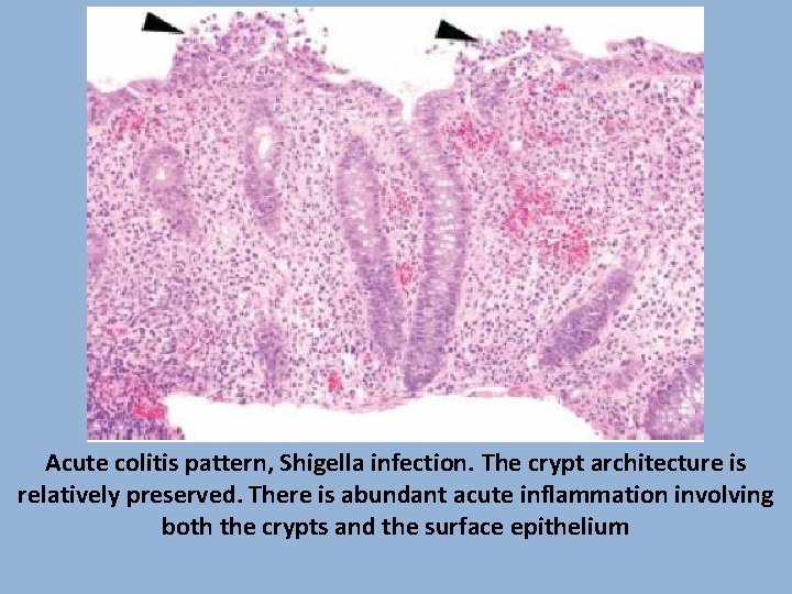 Acute colitis pattern, Shigella infection. The crypt architecture is relatively preserved. There is abundant