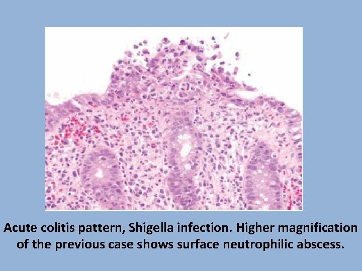 Acute colitis pattern, Shigella infection. Higher magnification of the previous case shows surface neutrophilic