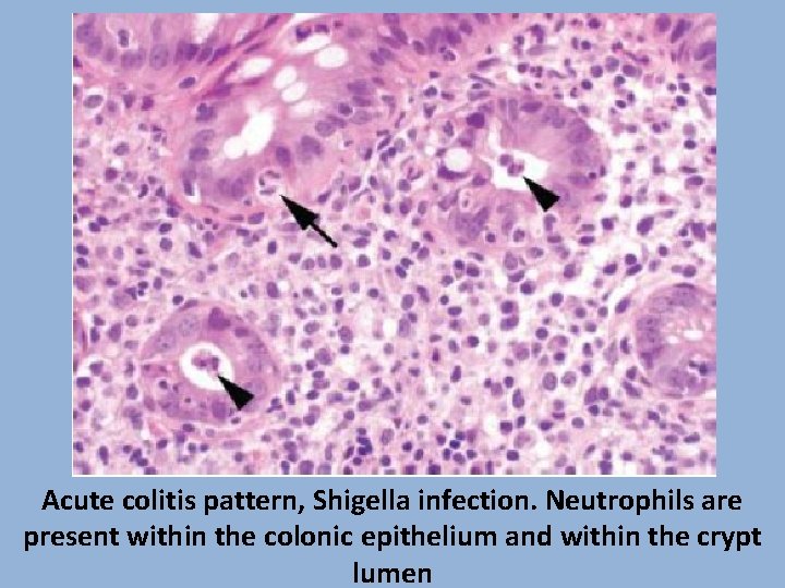 Acute colitis pattern, Shigella infection. Neutrophils are present within the colonic epithelium and within