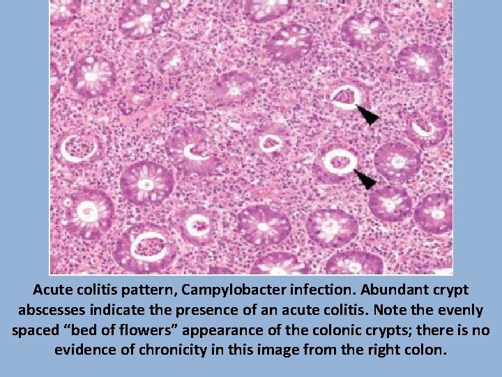 Acute colitis pattern, Campylobacter infection. Abundant crypt abscesses indicate the presence of an acute