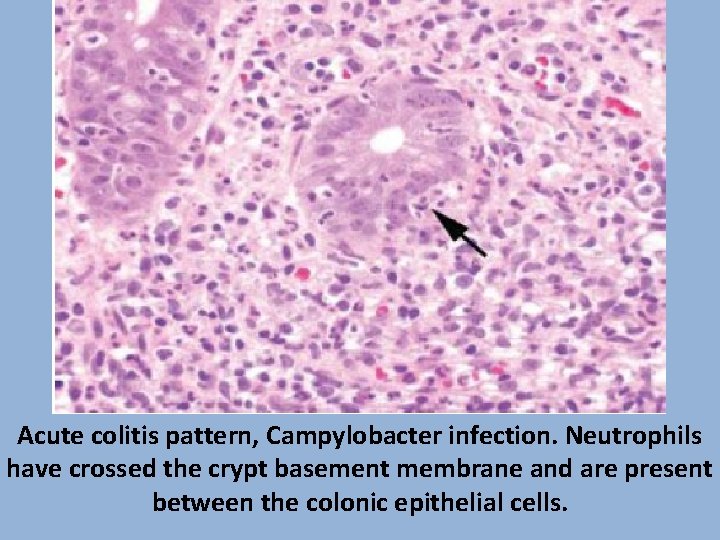 Acute colitis pattern, Campylobacter infection. Neutrophils have crossed the crypt basement membrane and are