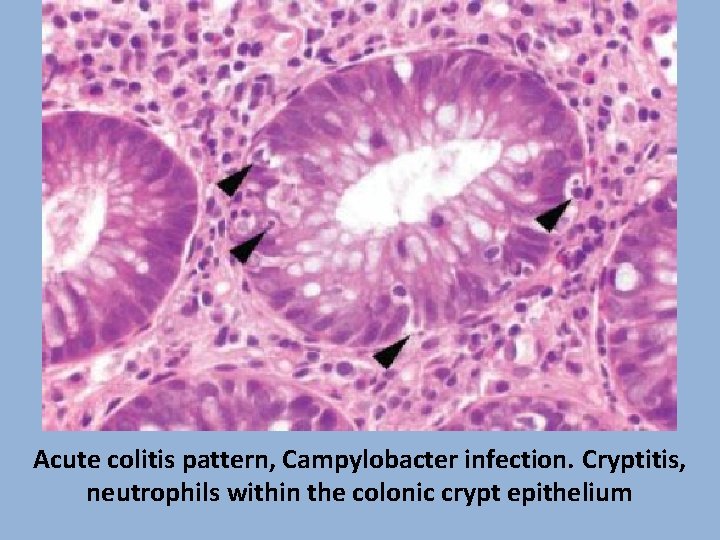 Acute colitis pattern, Campylobacter infection. Cryptitis, neutrophils within the colonic crypt epithelium 