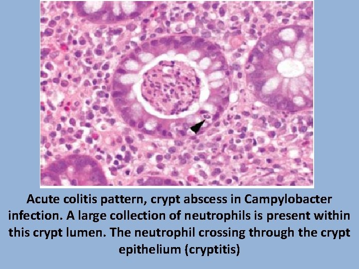 Acute colitis pattern, crypt abscess in Campylobacter infection. A large collection of neutrophils is