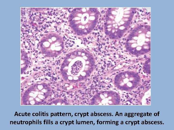 Acute colitis pattern, crypt abscess. An aggregate of neutrophils fills a crypt lumen, forming