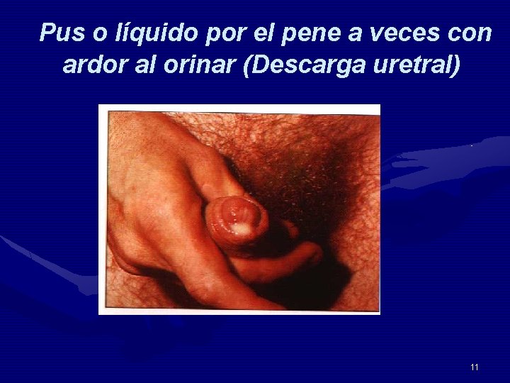 Pus o líquido por el pene a veces con ardor al orinar (Descarga uretral)