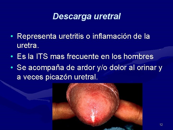 Descarga uretral • Representa uretritis o inflamación de la uretra. • Es la ITS