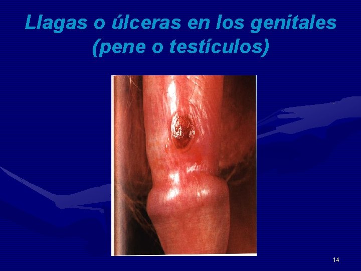 Llagas o úlceras en los genitales (pene o testículos) 14 