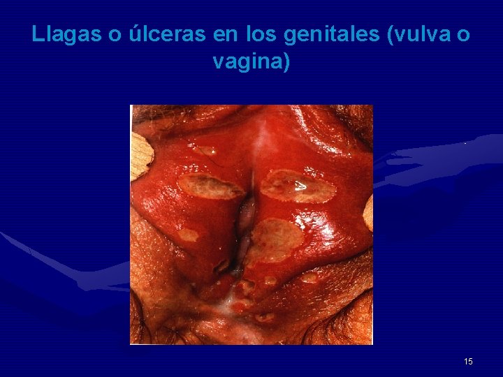 Llagas o úlceras en los genitales (vulva o vagina) 15 