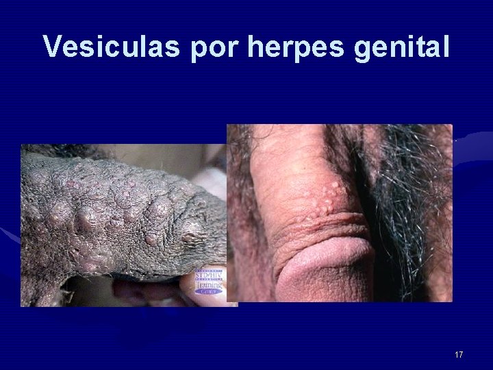 Vesiculas por herpes genital 17 