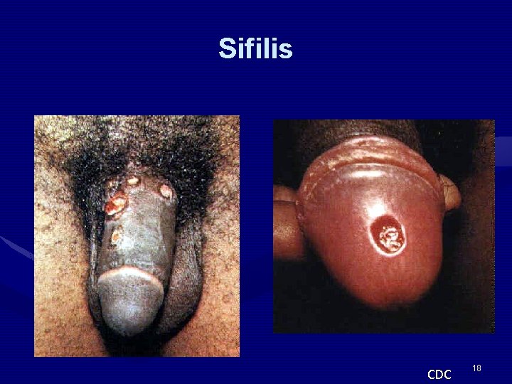 Sifilis CDC 18 