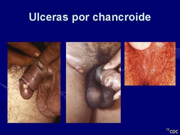Ulceras por chancroide 19 CDC 