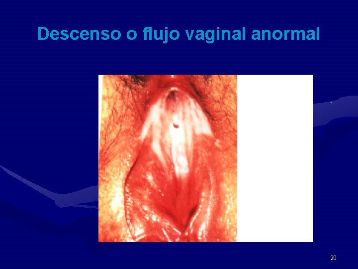 Descenso o flujo vaginal anormal 20 