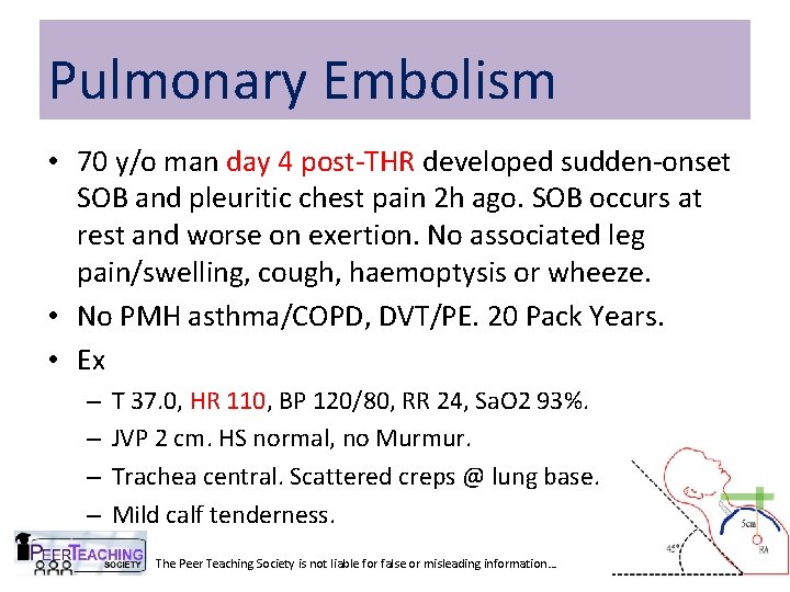 Pulmonary Embolism • 70 y/o man day 4 post-THR developed sudden-onset SOB and pleuritic
