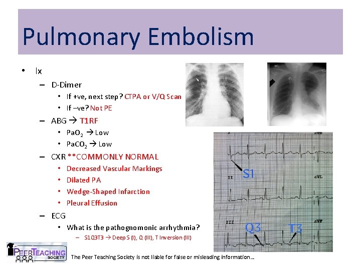 Pulmonary Embolism • Ix – D-Dimer • If +ve, next step? CTPA or V/Q