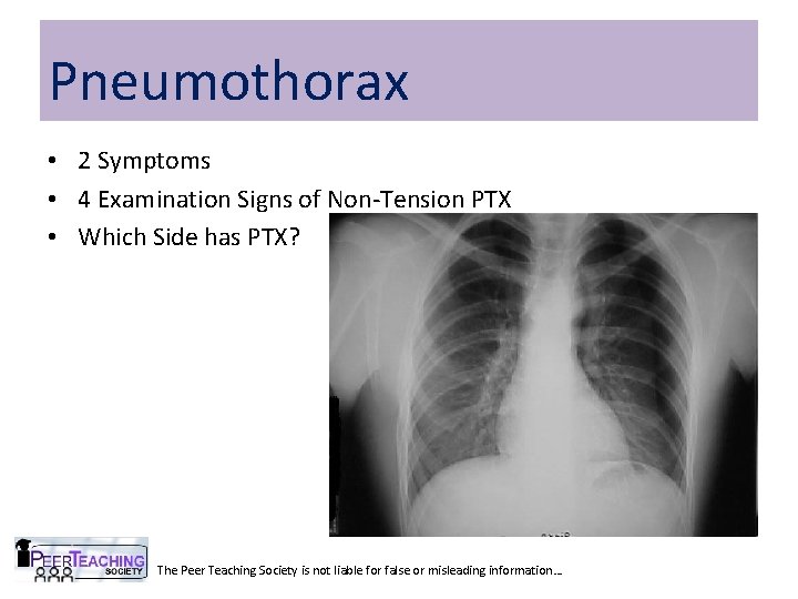 Pneumothorax • 2 Symptoms • 4 Examination Signs of Non-Tension PTX • Which Side