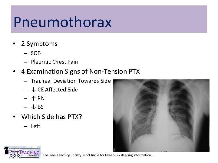 Pneumothorax • 2 Symptoms – SOB – Pleuritic Chest Pain • 4 Examination Signs