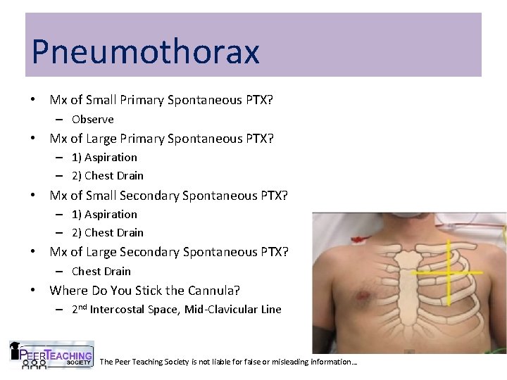 Pneumothorax • Mx of Small Primary Spontaneous PTX? – Observe • Mx of Large