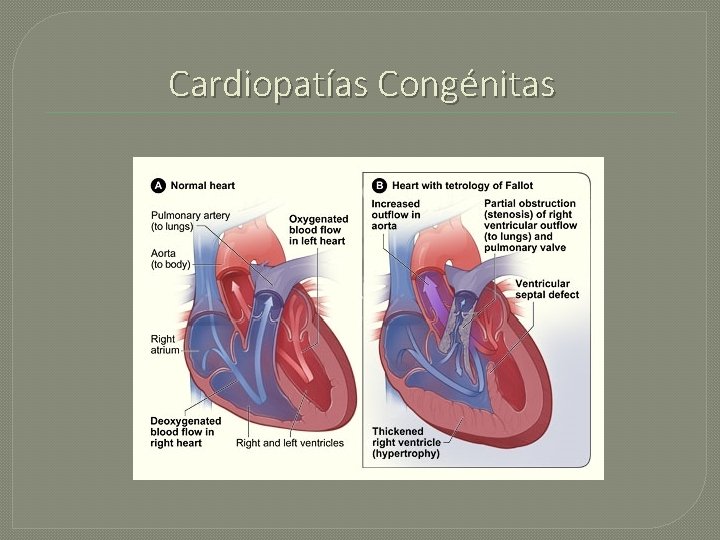 Cardiopatías Congénitas 