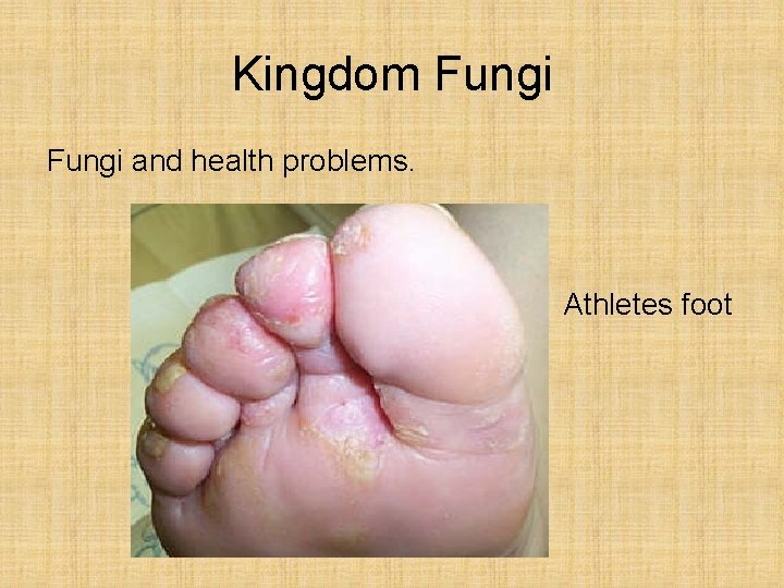 Kingdom Fungi and health problems. Athletes foot 