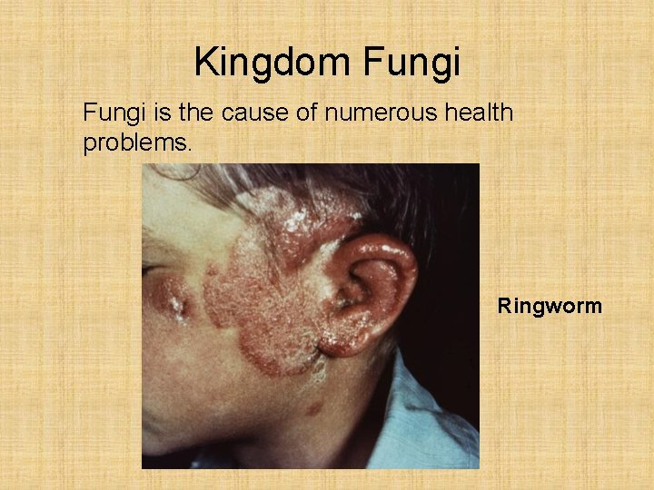 Kingdom Fungi is the cause of numerous health problems. Ringworm 