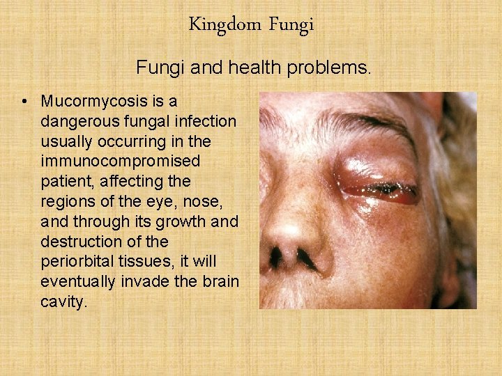 Kingdom Fungi and health problems. • Mucormycosis is a dangerous fungal infection usually occurring