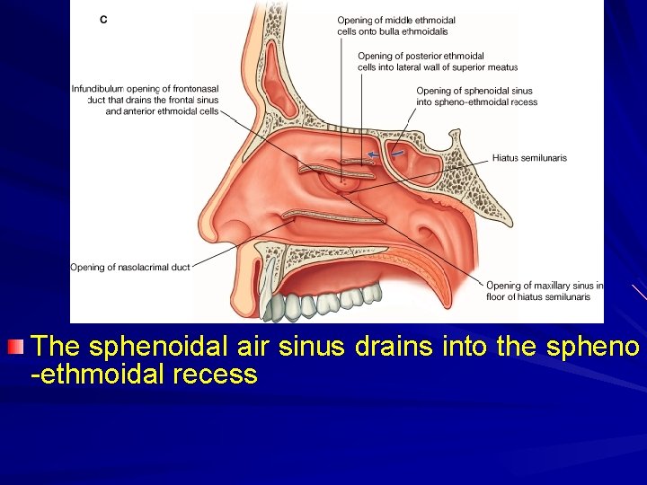 The sphenoidal air sinus drains into the spheno -ethmoidal recess 