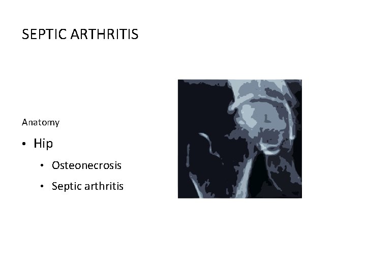 SEPTIC ARTHRITIS Anatomy • Hip • Osteonecrosis • Septic arthritis 