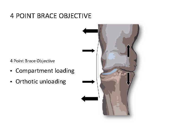 4 POINT BRACE OBJECTIVE 4 Point Brace Objective • Compartment loading • Orthotic unloading