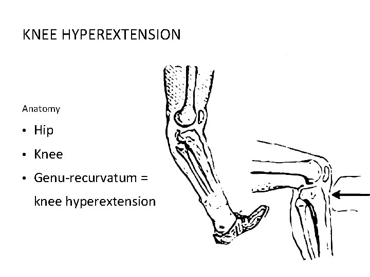 KNEE HYPEREXTENSION Anatomy • Hip • Knee • Genu-recurvatum = knee hyperextension 