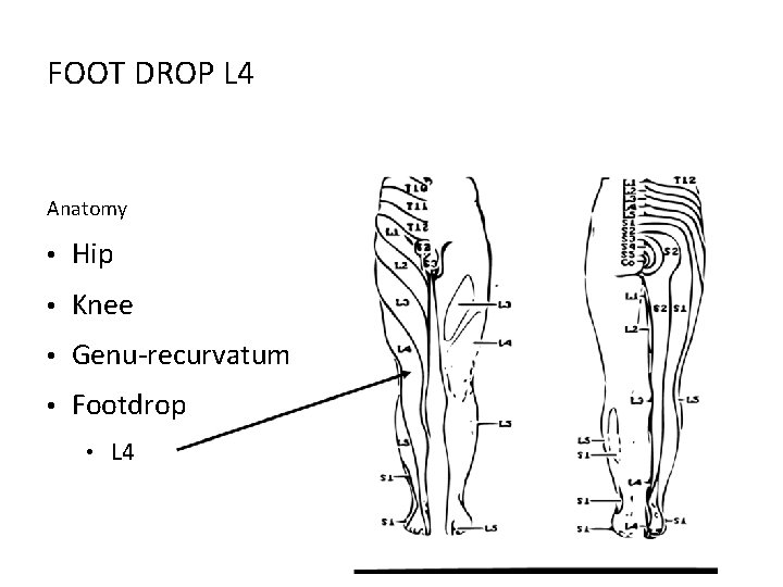 FOOT DROP L 4 Anatomy • Hip • Knee • Genu-recurvatum • Footdrop •