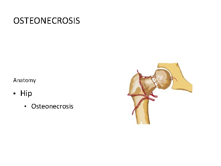 OSTEONECROSIS Anatomy • Hip • Osteonecrosis 