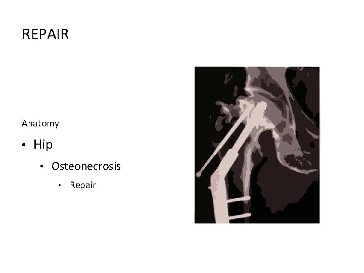 REPAIR Anatomy • Hip • Osteonecrosis • Repair 