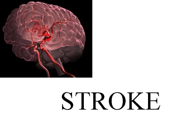 STROKE 