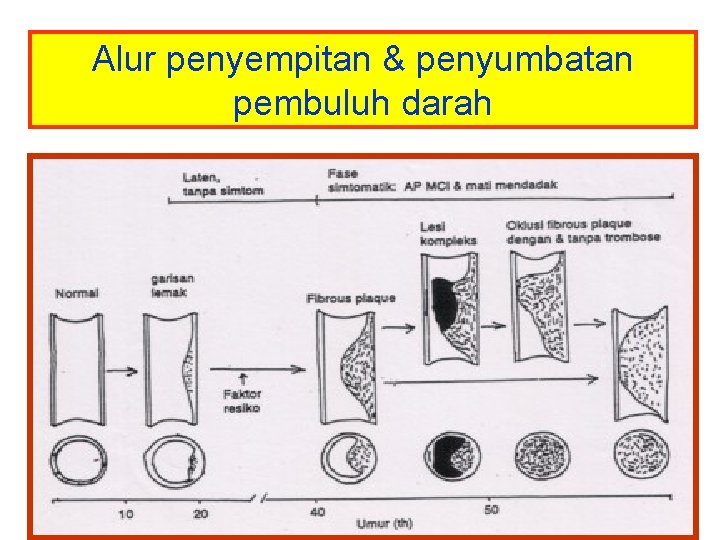 Alur penyempitan & penyumbatan pembuluh darah 