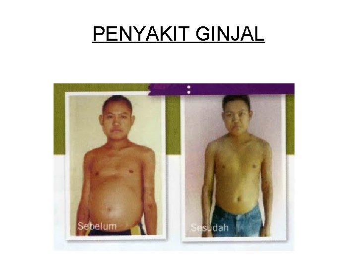 PENYAKIT GINJAL 