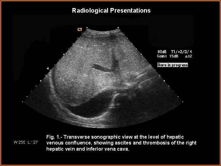 Radiological Presentations Fig. 1. - Transverse sonographic view at the level of hepatic venous