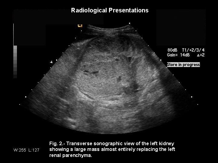 Radiological Presentations Fig. 2. - Transverse sonographic view of the left kidney showing a